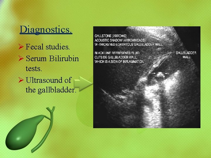 Diagnostics. Ø Fecal studies. Ø Serum Bilirubin tests. Ø Ultrasound of the gallbladder. 
