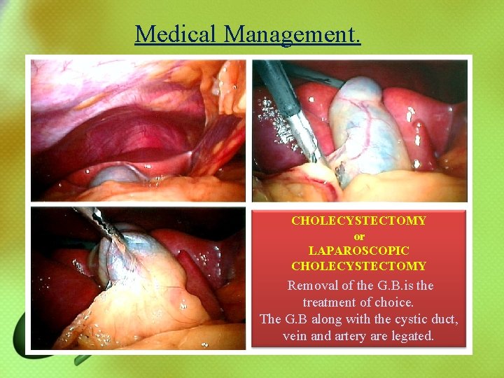 Medical Management. CHOLECYSTECTOMY or LAPAROSCOPIC CHOLECYSTECTOMY Removal of the G. B. is the treatment