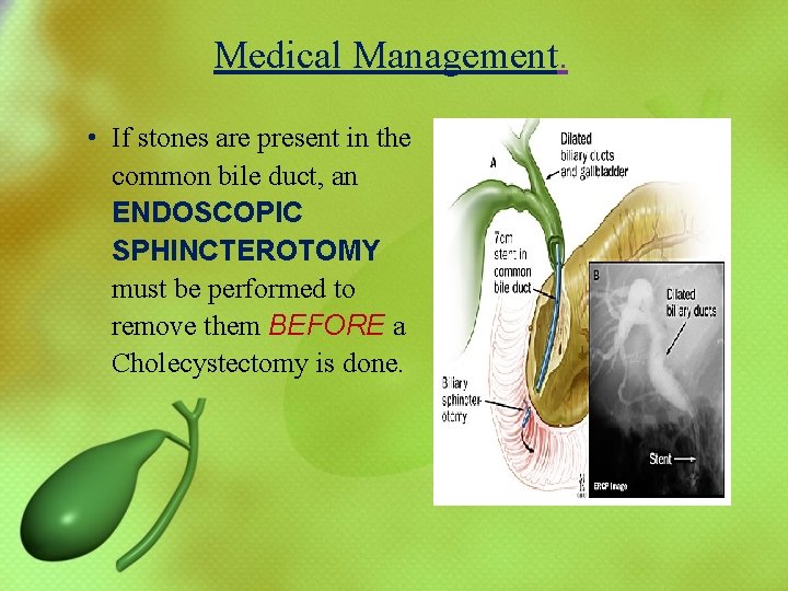 Medical Management. • If stones are present in the common bile duct, an ENDOSCOPIC