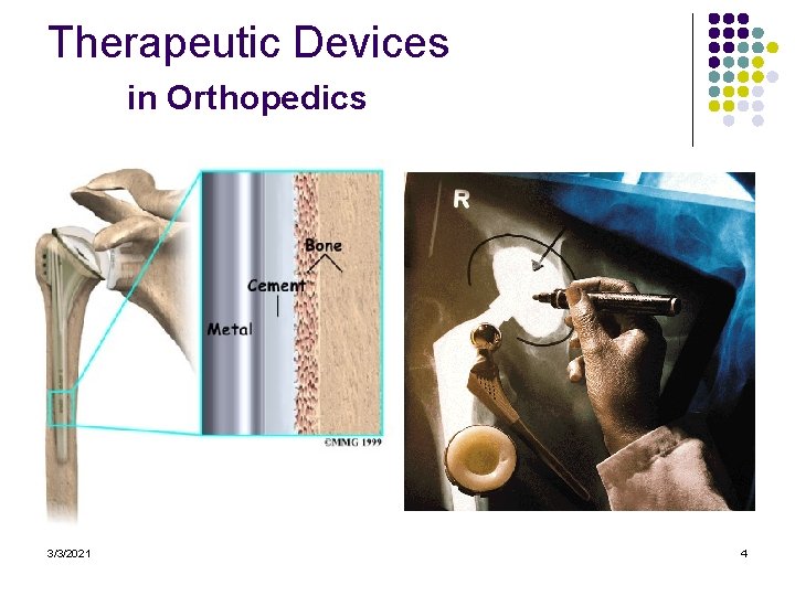 Therapeutic Devices in Orthopedics 3/3/2021 4 