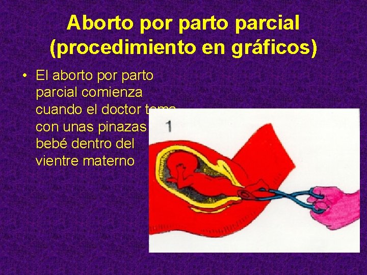 Aborto por parto parcial (procedimiento en gráficos) • El aborto por parto parcial comienza