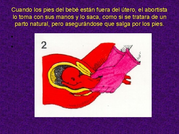 Cuando los pies del bebé están fuera del útero, el abortista lo toma con