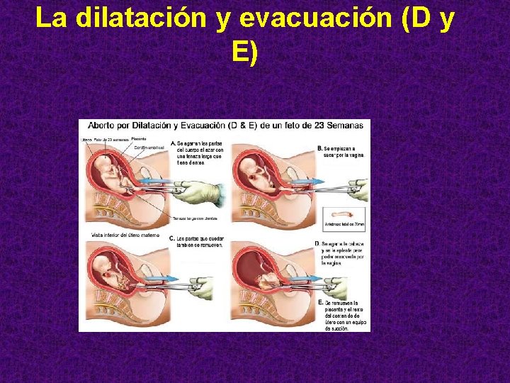 La dilatación y evacuación (D y E) 