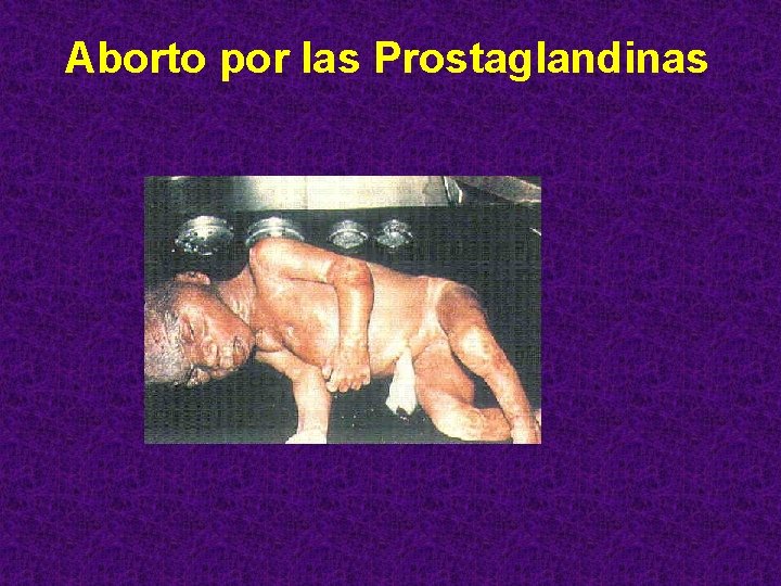 Aborto por las Prostaglandinas 