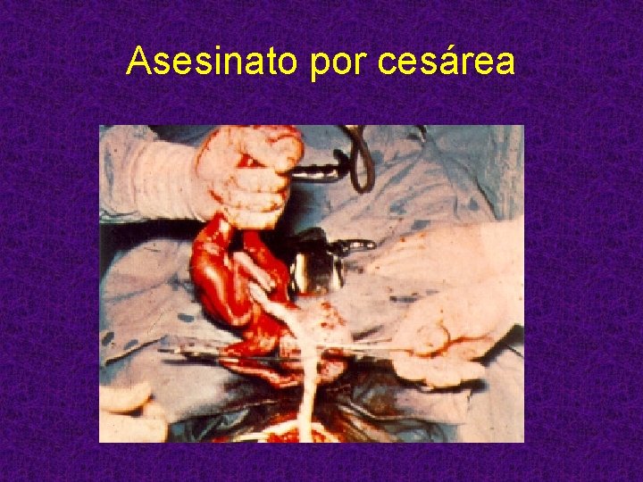 Asesinato por cesárea 