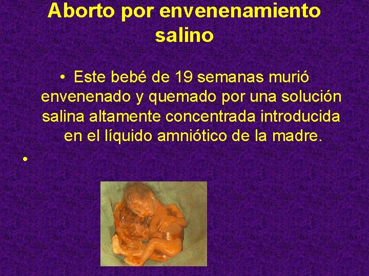 Aborto por envenenamiento salino • Este bebé de 19 semanas murió envenenado y quemado