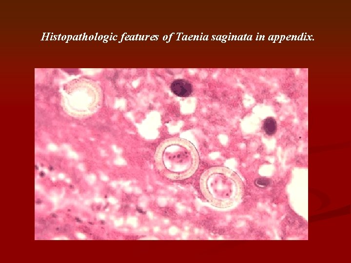 Histopathologic features of Taenia saginata in appendix. 