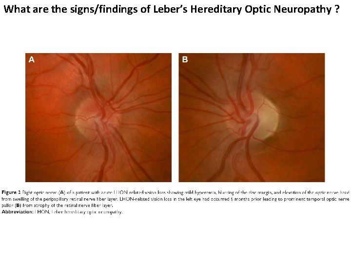 What are the signs/findings of Leber’s Hereditary Optic Neuropathy ?  What are the signs/findings of Leber’s Hereditary Optic Neuropathy ?