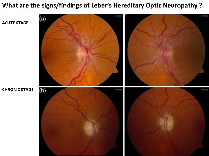 What are the signs/findings of Leber’s Hereditary Optic Neuropathy ? ACUTE STAGE CHRONIC STAGE What are the signs/findings of Leber’s Hereditary Optic Neuropathy ? ACUTE STAGE CHRONIC STAGE