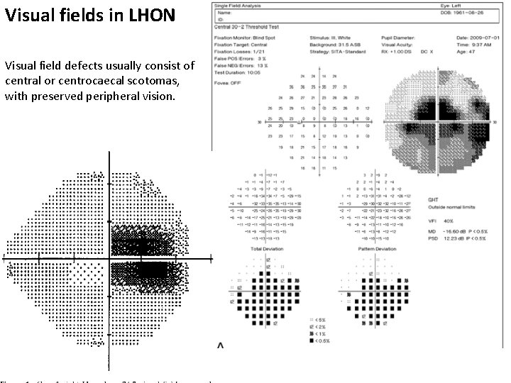 Visual fields in LHON Visual field defects usually consist of central or centrocaecal scotomas,