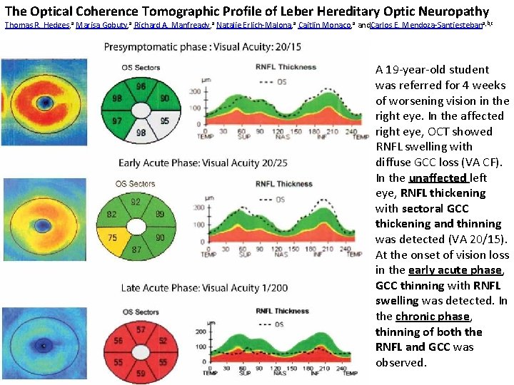 The Optical Coherence Tomographic Profile of Leber Hereditary Optic Neuropathy Thomas R. Hedges, a