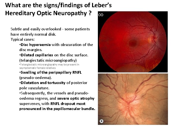 What are the signs/findings of Leber’s Hereditary Optic Neuropathy ? Subtle and easily overlooked What are the signs/findings of Leber’s Hereditary Optic Neuropathy ? Subtle and easily overlooked