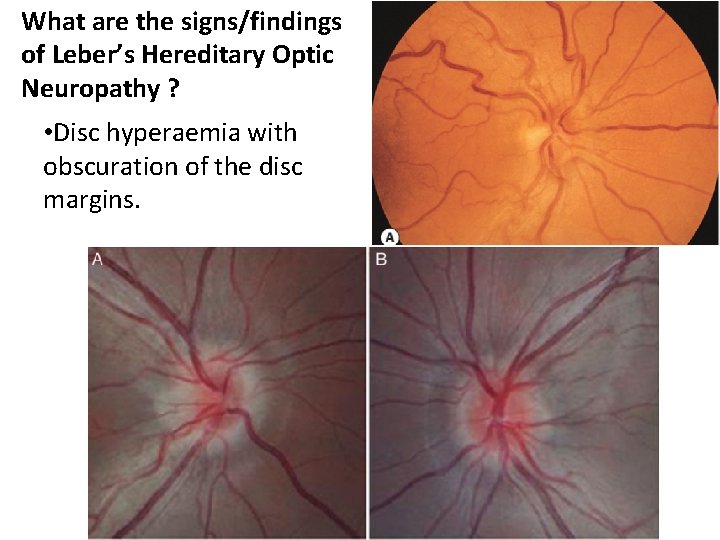 What are the signs/findings of Leber’s Hereditary Optic Neuropathy ? • Disc hyperaemia with What are the signs/findings of Leber’s Hereditary Optic Neuropathy ? • Disc hyperaemia with