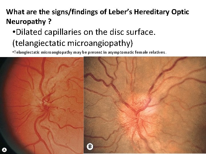 What are the signs/findings of Leber’s Hereditary Optic Neuropathy ? • Dilated capillaries on