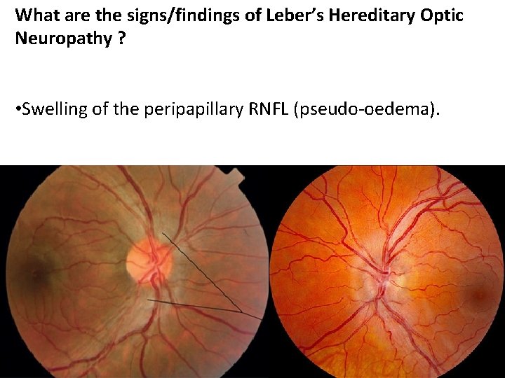 What are the signs/findings of Leber’s Hereditary Optic Neuropathy ? • Swelling of the What are the signs/findings of Leber’s Hereditary Optic Neuropathy ? • Swelling of the