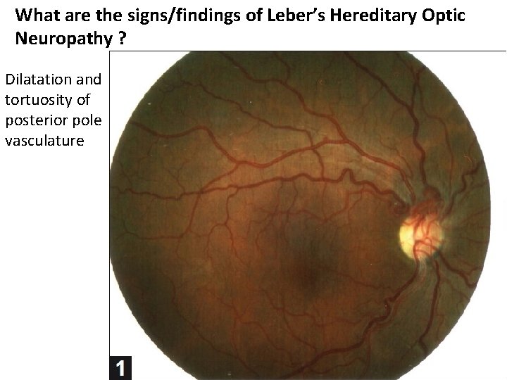 What are the signs/findings of Leber’s Hereditary Optic Neuropathy ? Dilatation and tortuosity of