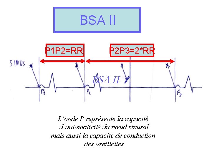 BSA II P 1 P 2=RR P 2 P 3=2*RR BSA II L’onde P