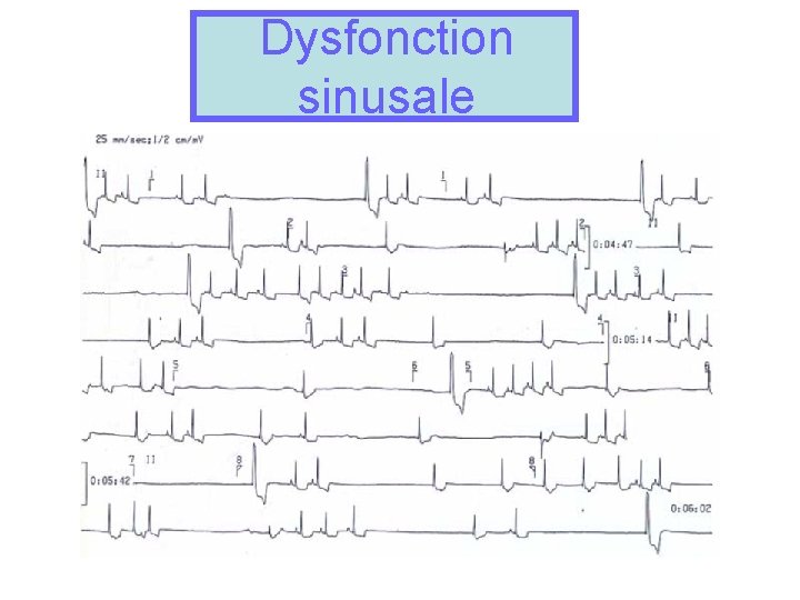 Dysfonction sinusale 