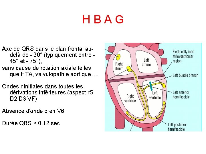 H B A G Axe de QRS dans le plan frontal audelà de -