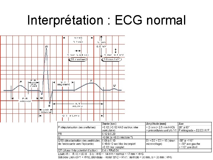 Interprétation : ECG normal 
