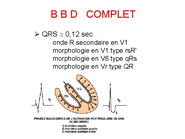 B B D COMPLET QRS 0, 12 sec onde R secondaire en V 1