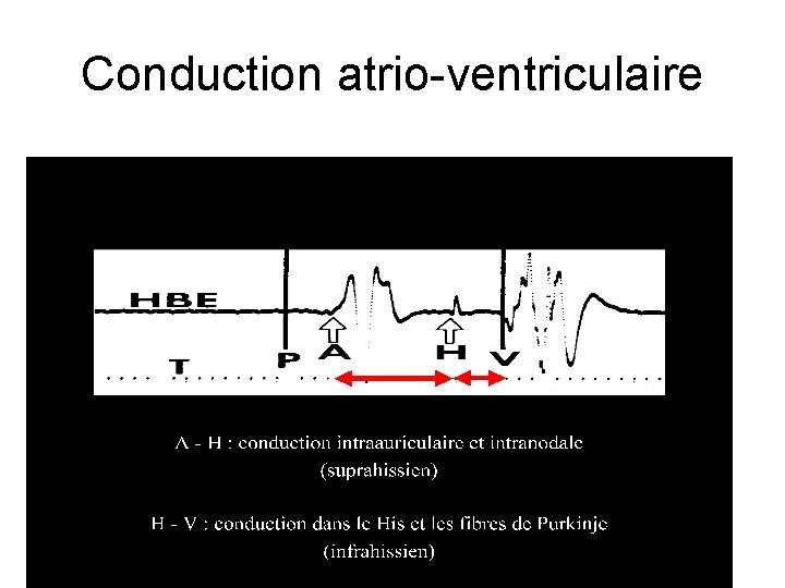 Conduction atrio-ventriculaire 