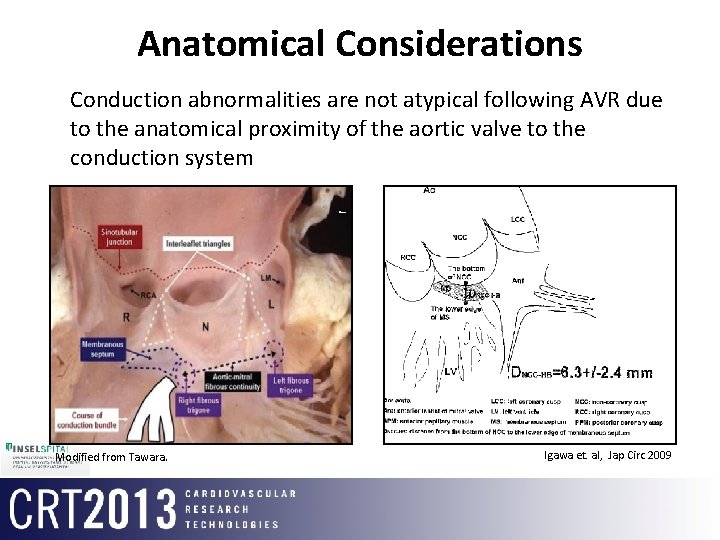 Anatomical Considerations • Conduction abnormalities are not atypical following AVR due to the anatomical