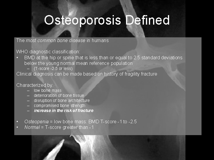 Osteoporosis Defined The most common bone disease in humans WHO diagnostic classification: • BMD