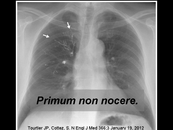 Primum non nocere. Tourtier JP, Cottez, S. N Engl J Med 366; 3 January