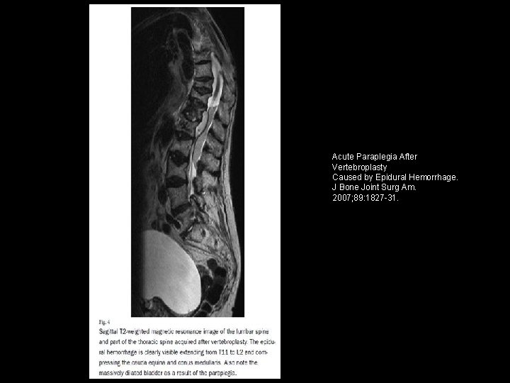 Acute Paraplegia After Vertebroplasty Caused by Epidural Hemorrhage. J Bone Joint Surg Am. 2007;