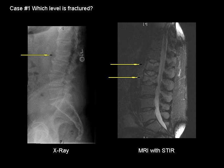 Case #1 Which level is fractured? X-Ray MRI with STIR 