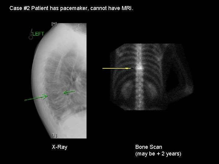 Case #2 Patient has pacemaker, cannot have MRI. X-Ray Bone Scan (may be +