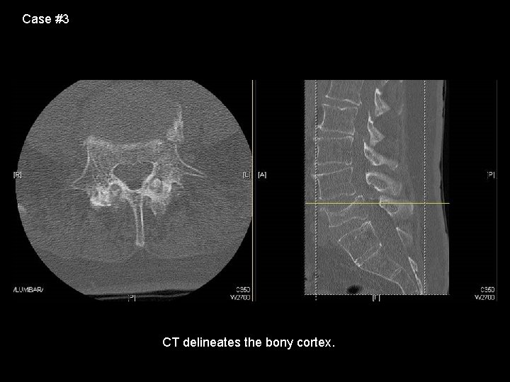 Case #3 CT delineates the bony cortex. 