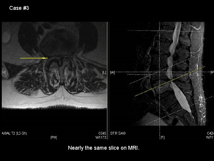 Case #3 Nearly the same slice on MRI. 