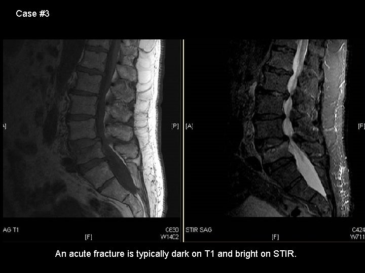 Case #3 An acute fracture is typically dark on T 1 and bright on