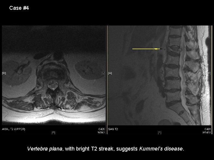 Case #4 Vertebra plana, with bright T 2 streak, suggests Kummel’s disease. 