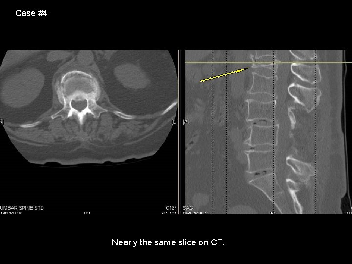 Case #4 Nearly the same slice on CT. 