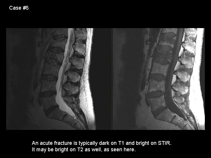 Case #5 An acute fracture is typically dark on T 1 and bright on