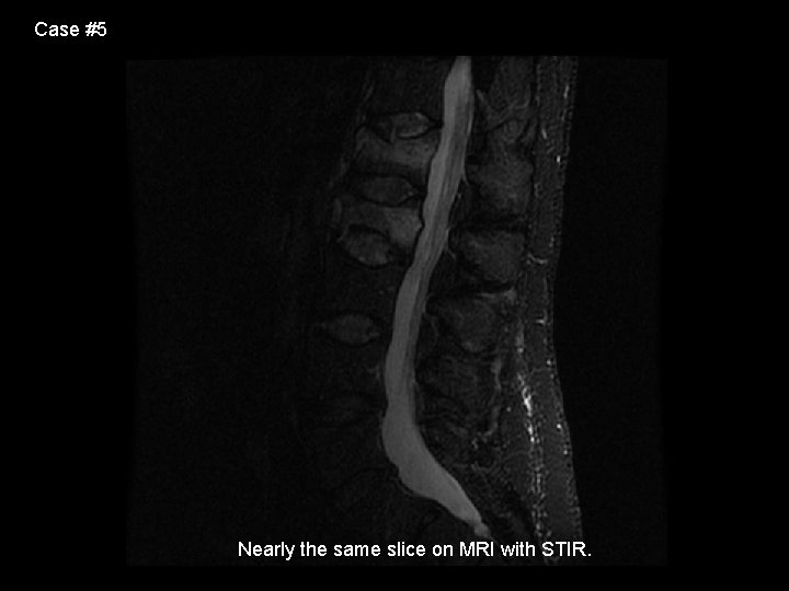 Case #5 Nearly the same slice on MRI with STIR. 