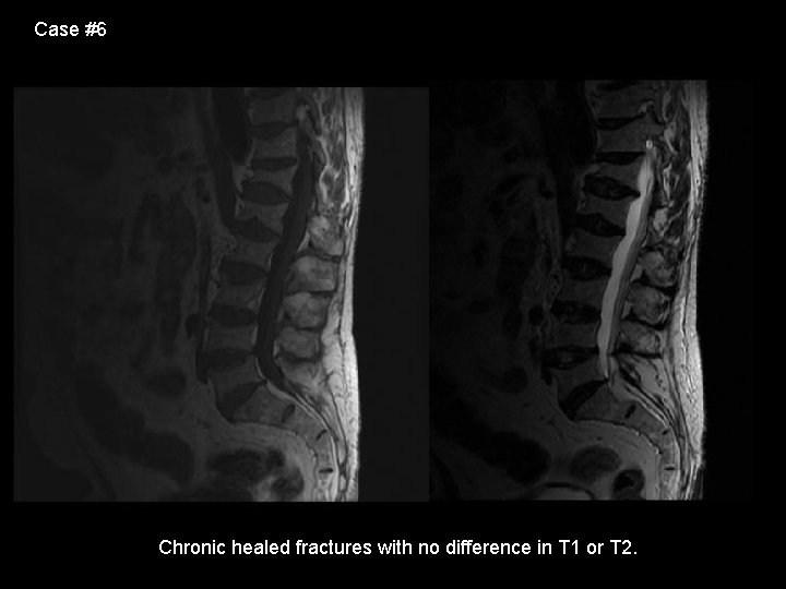 Case #6 Chronic healed fractures with no difference in T 1 or T 2.