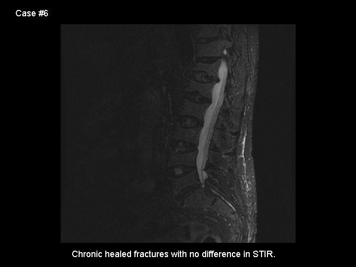 Case #6 Chronic healed fractures with no difference in STIR. 