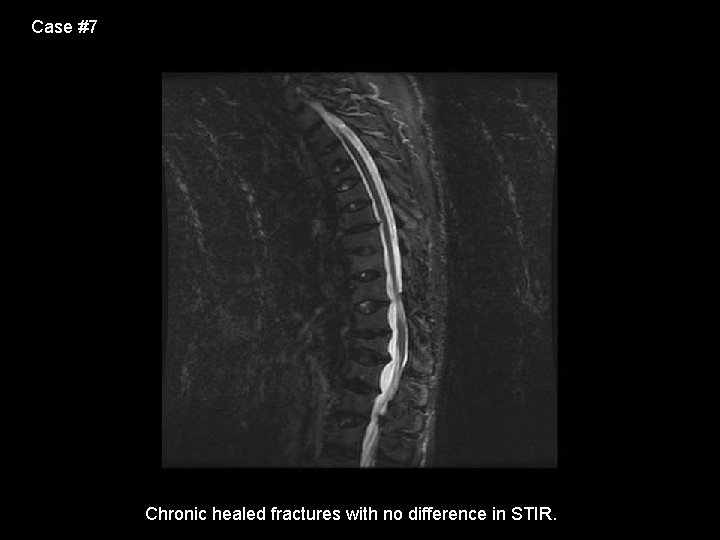 Case #7 Chronic healed fractures with no difference in STIR. 