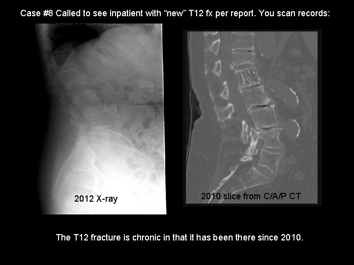 Case #8 Called to see inpatient with “new” T 12 fx per report. You