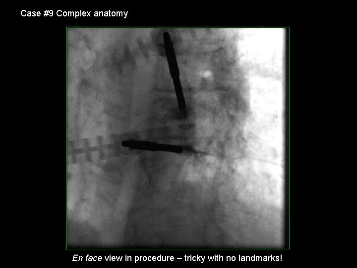 Case #9 Complex anatomy En face view in procedure – tricky with no landmarks!