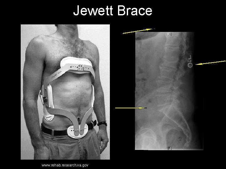 Jewett Brace www. rehab. research. va. gov 