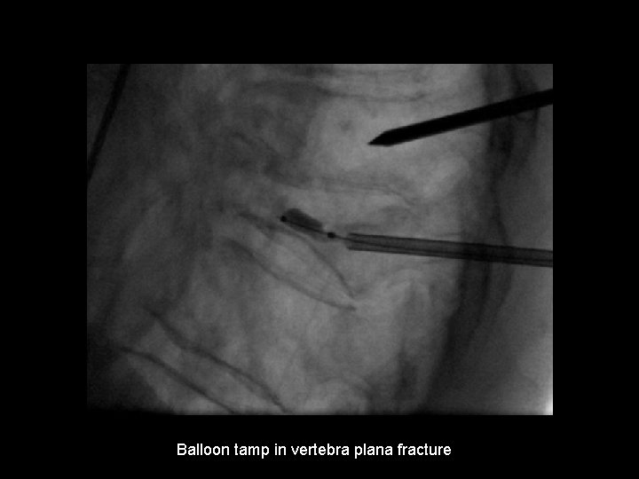 Balloon tamp in vertebra plana fracture 