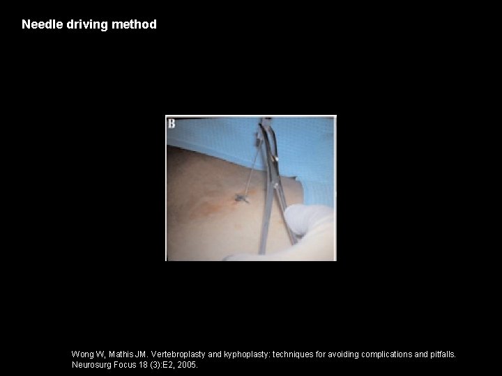 Needle driving method Wong W, Mathis JM. Vertebroplasty and kyphoplasty: techniques for avoiding complications