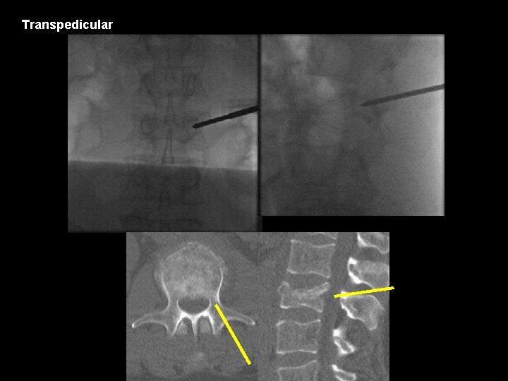 Transpedicular 