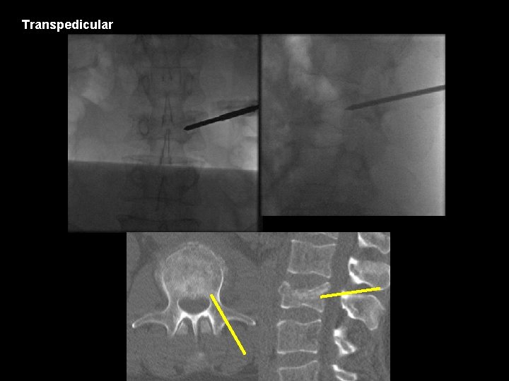 Transpedicular 