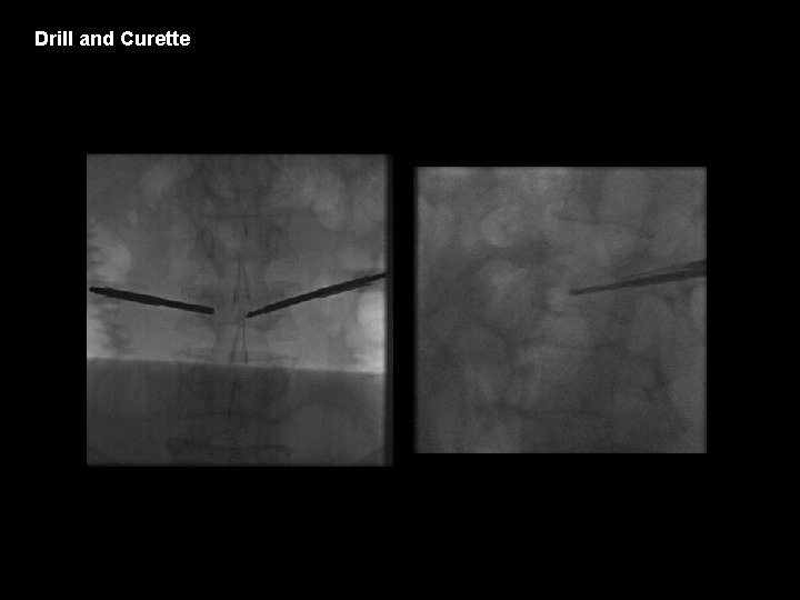 Drill and Curette 